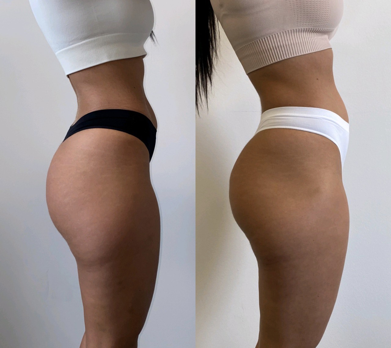 Body sculpting transformation result